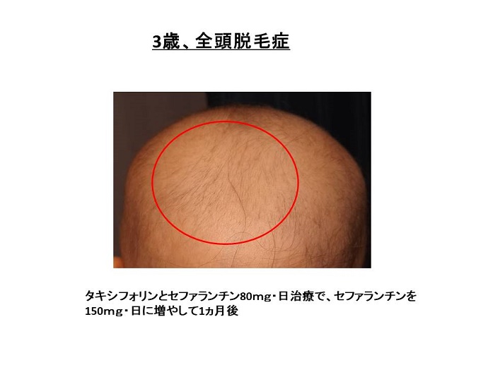 円形脱毛症　病院""